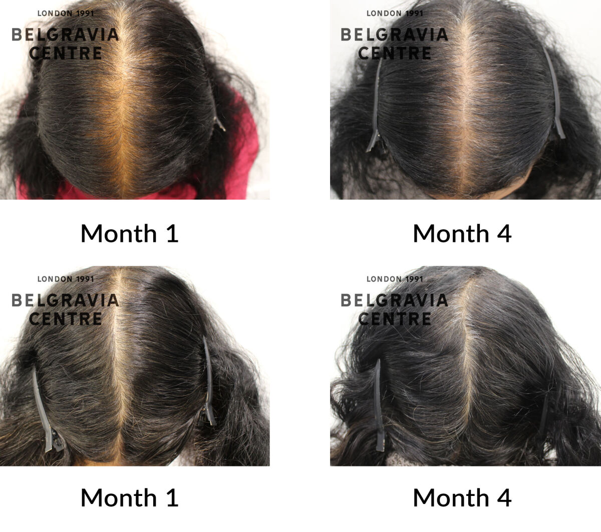 female pattern hair loss the belgravia centre 447857