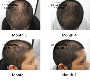 male pattern hair loss the belgravia centre 467874