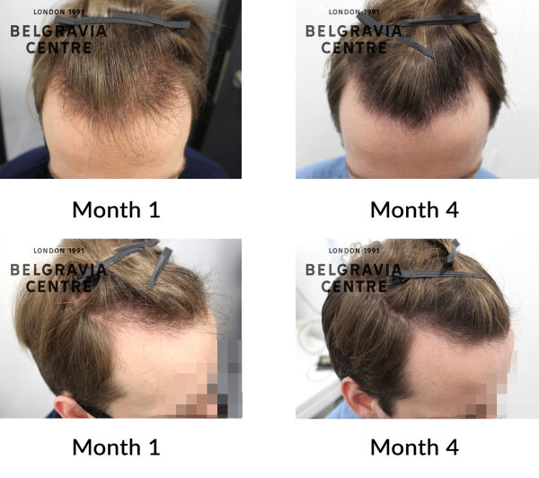 male pattern hair loss the belgravia centre 437483