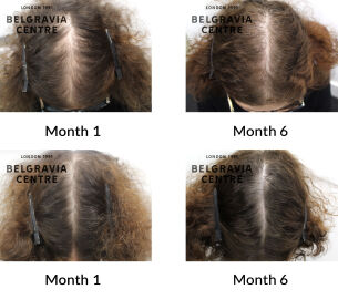 female pattern hair loss the belgravia centre 432358