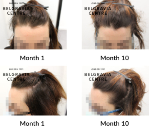 female pattern hair loss the belgravia centre 420397 1024x907