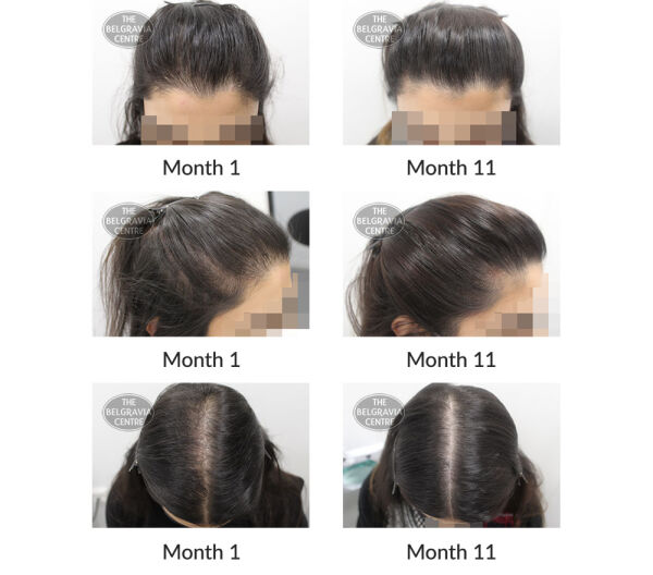 female pattern hair loss and telogen effluvium the belgravia centre 393434 06 11 2020