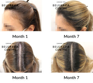 female pattern hair loss the belgravia centre 432013