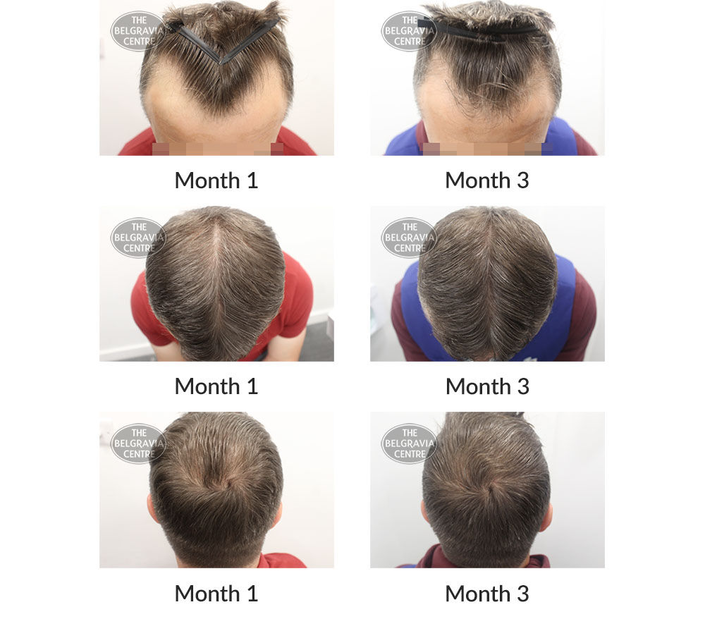 male pattern hair loss the belgravia centre 404735 29 10 2020