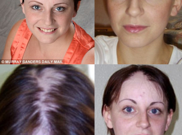 Sarah Ford Loses Hair Alopecia Grows Back Chest Infection Steriod Medication