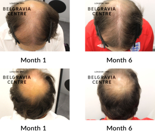 male pattern hair loss the belgravia centre 444724