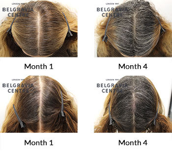 alert female pattern hair loss and telogen effluvium the belgravia centre 430435