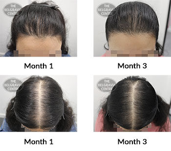 alert female pattern hair loss the belgravia centre 393036 16 09 2021