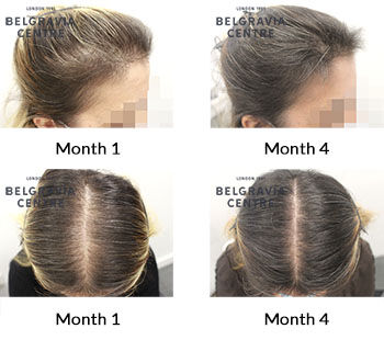 alert female pattern hair loss the belgravia centre 050122