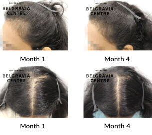 female pattern hair loss the belgravia centre 451691