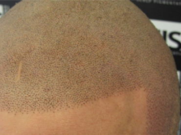 Scalp Micropigmentation Tattoos to Cover Hair Loss1