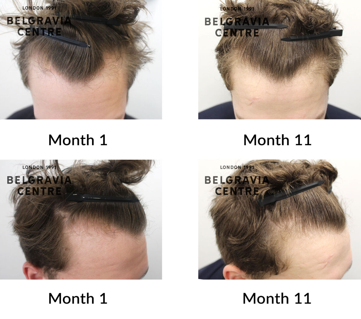 male pattern hair loss the belgravia centre 440693