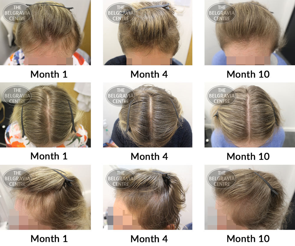 female pattern hair loss the belgravia centre 362817 25 02 2019
