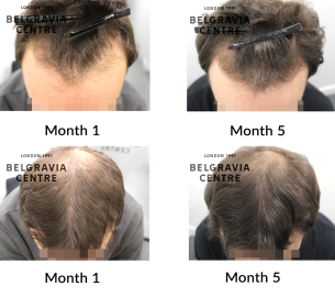 male pattern hair loss the belgravia centre 467132