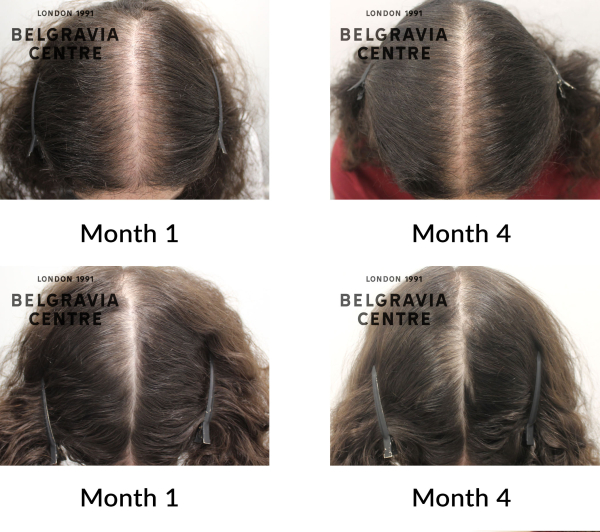 female pattern hair loss the belgravia centre 425637