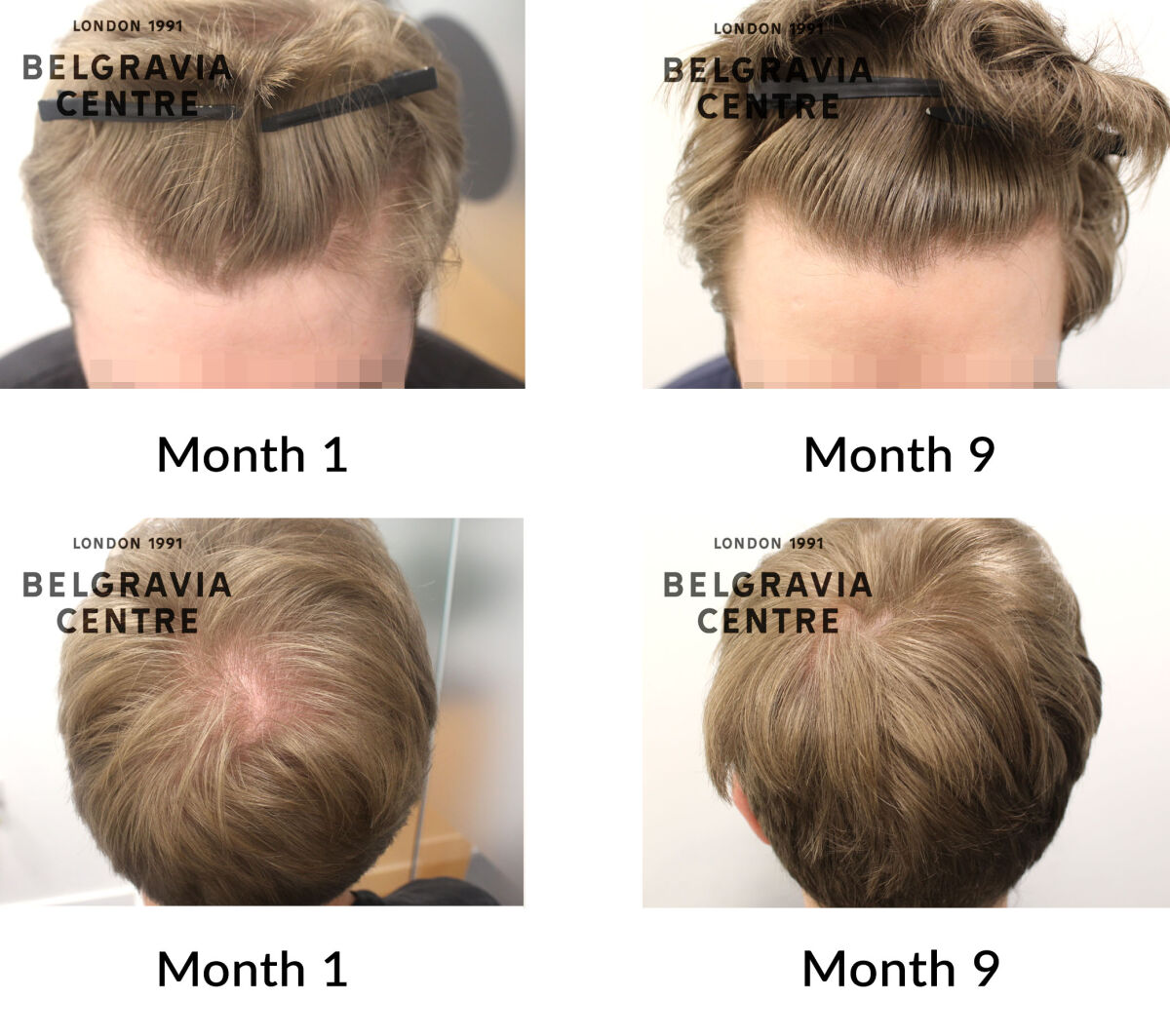 male pattern hair loss the belgravia centre 442086
