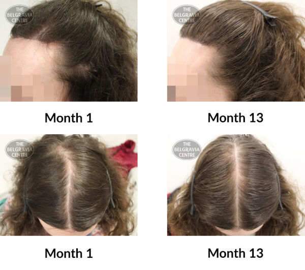 female pattern hair loss the belgravia centre 377795 01 05 2020