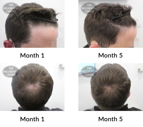 Hair Growth Success Story: 