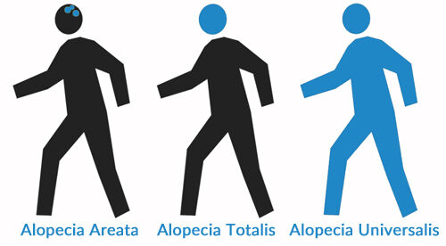 Areas of the Head and Body Affected By Alopecia Areata 