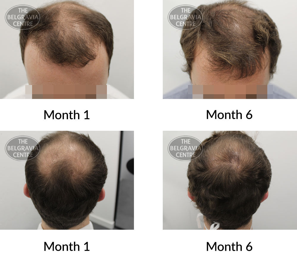 male pattern hair loss the belgravia centre 396097 11 08 2020