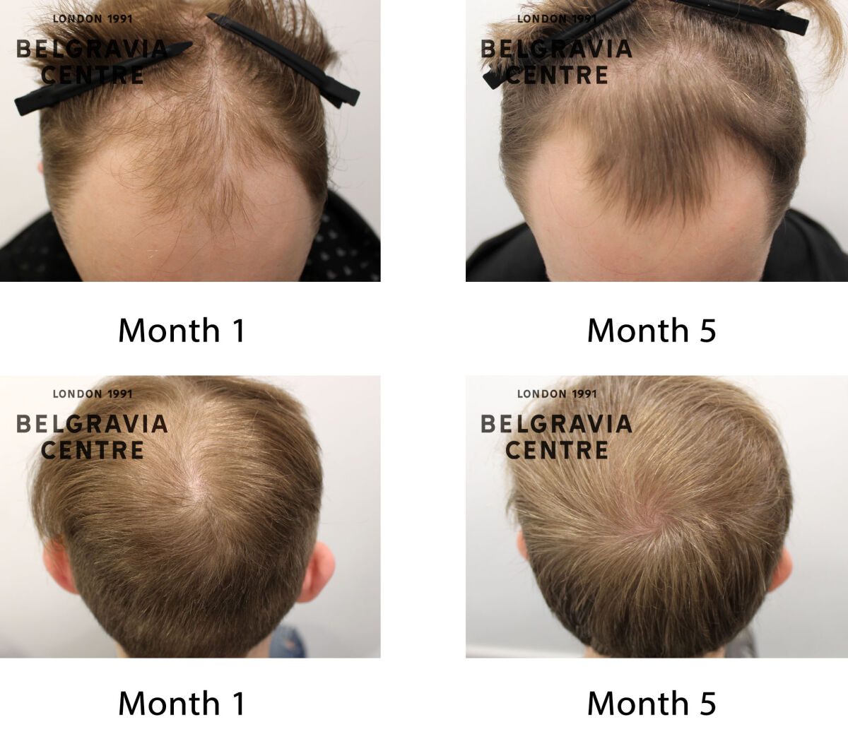 male pattern hair loss the belgravia centre 440398