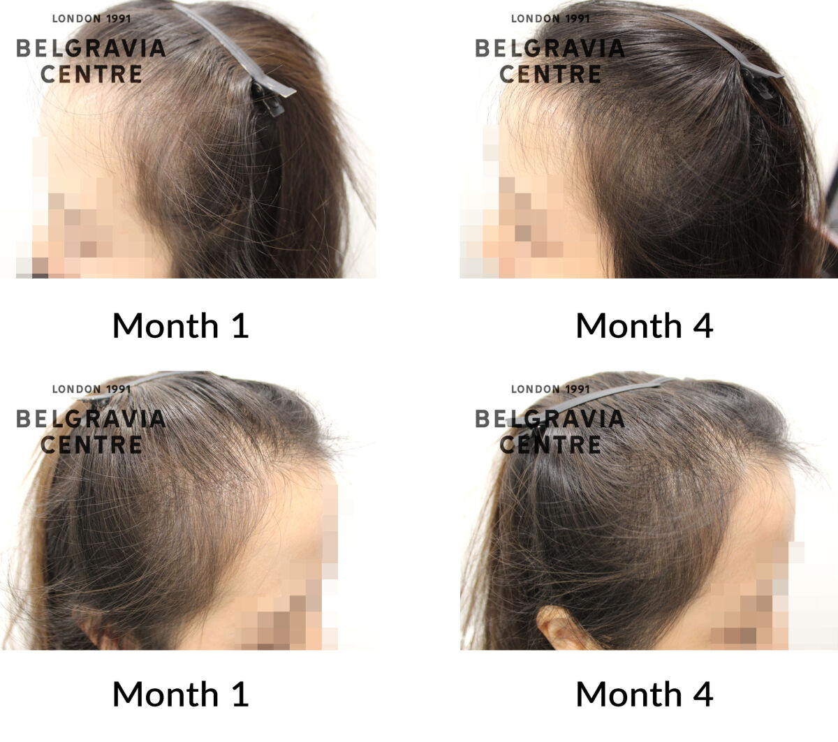 female pattern hair loss the belgravia centre 449944