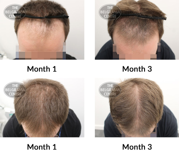 male pattern hair loss the belgravia centre 380552 04 07 2019
