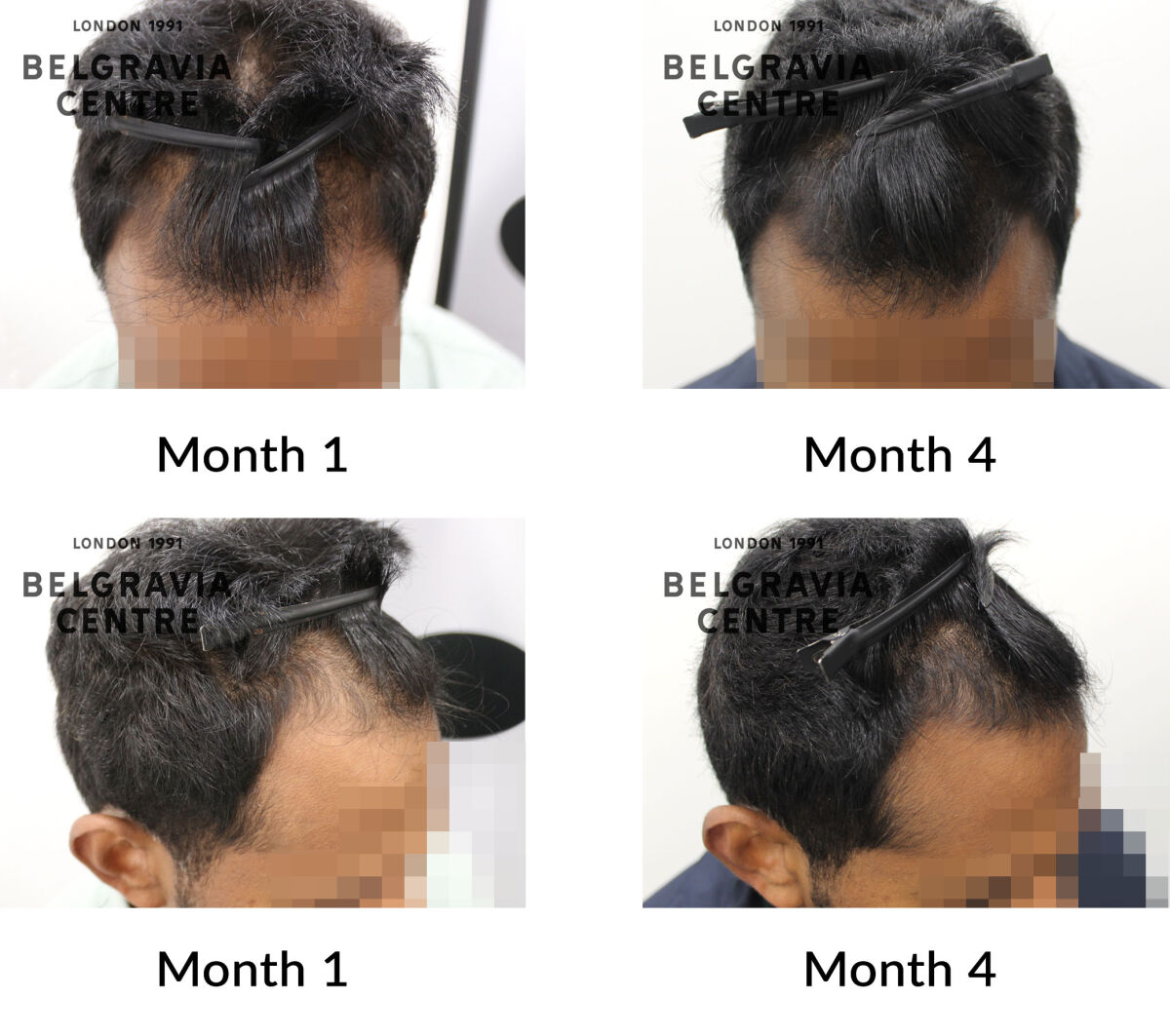 male pattern hair loss the belgravia centre 447971