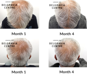 male pattern hair loss the belgravia centre 461327