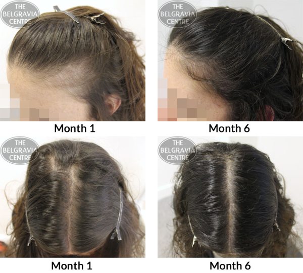 Female Pattern Hair Loss The Belgravia Centre AF 04 08