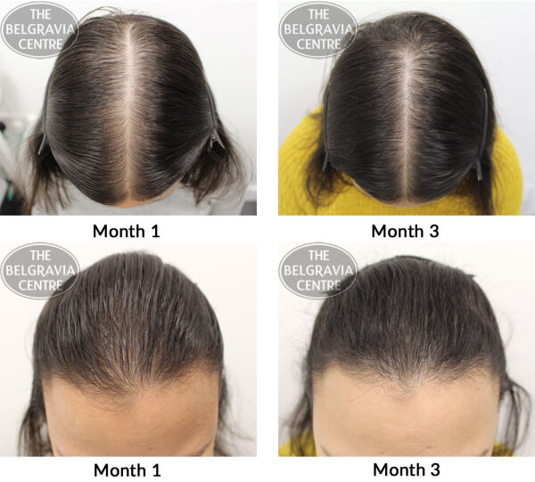 female pattern hair loss the belgravia centre np 27 12 2018