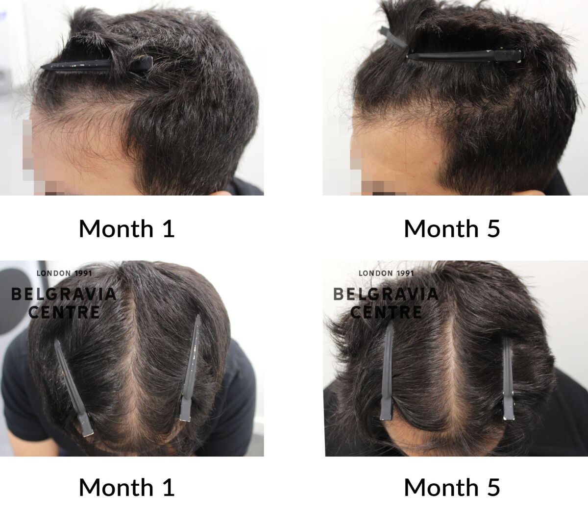 male pattern hair loss the belgravia centre 447475