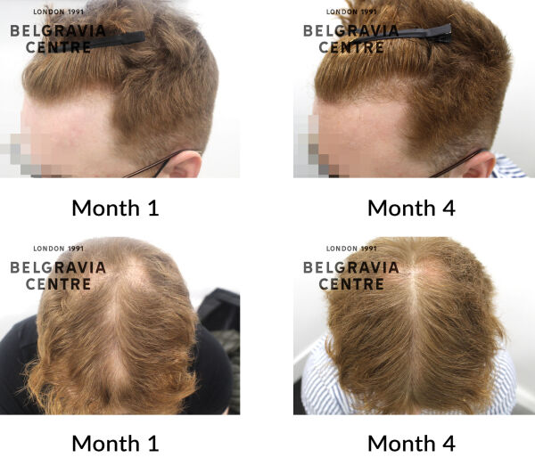 male pattern hair loss the belgravia centre 434290