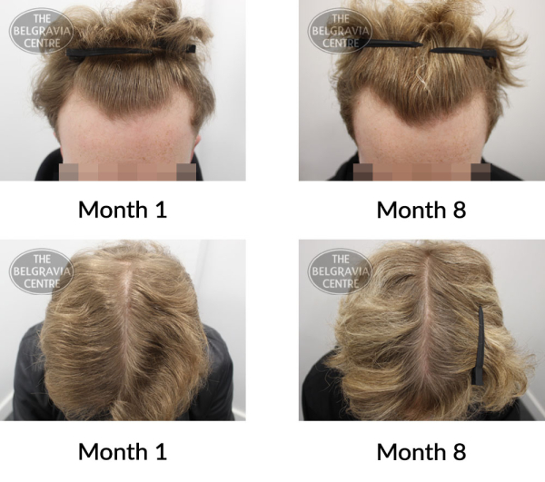male pattern hair loss the belgravia centre 408301 01 07 2021