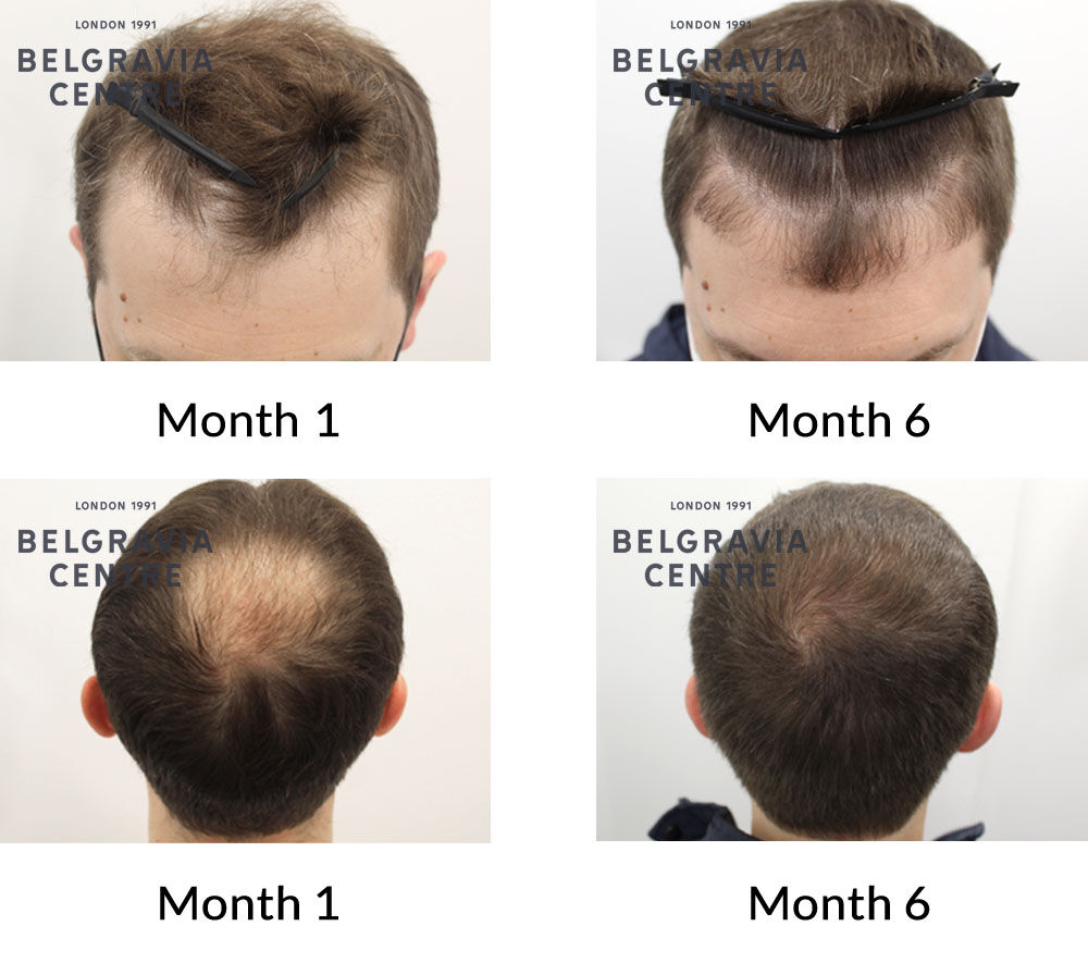 Hair Growth Success Story: 
