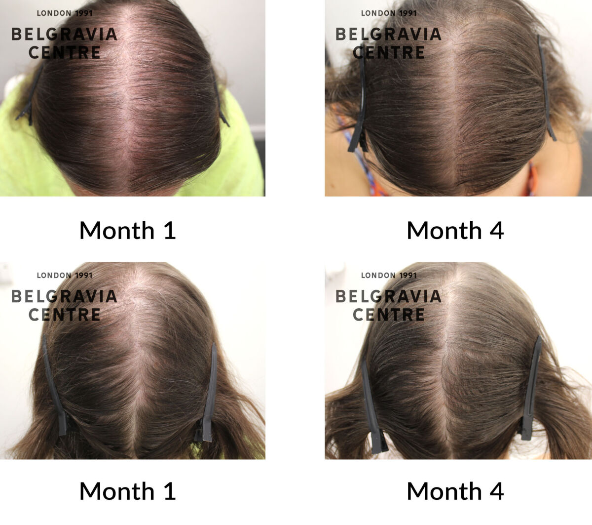 female pattern hair loss and diffuse hair loss the belgravia centre 349275
