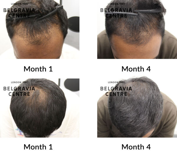 male pattern hair loss the belgravia centre 442220