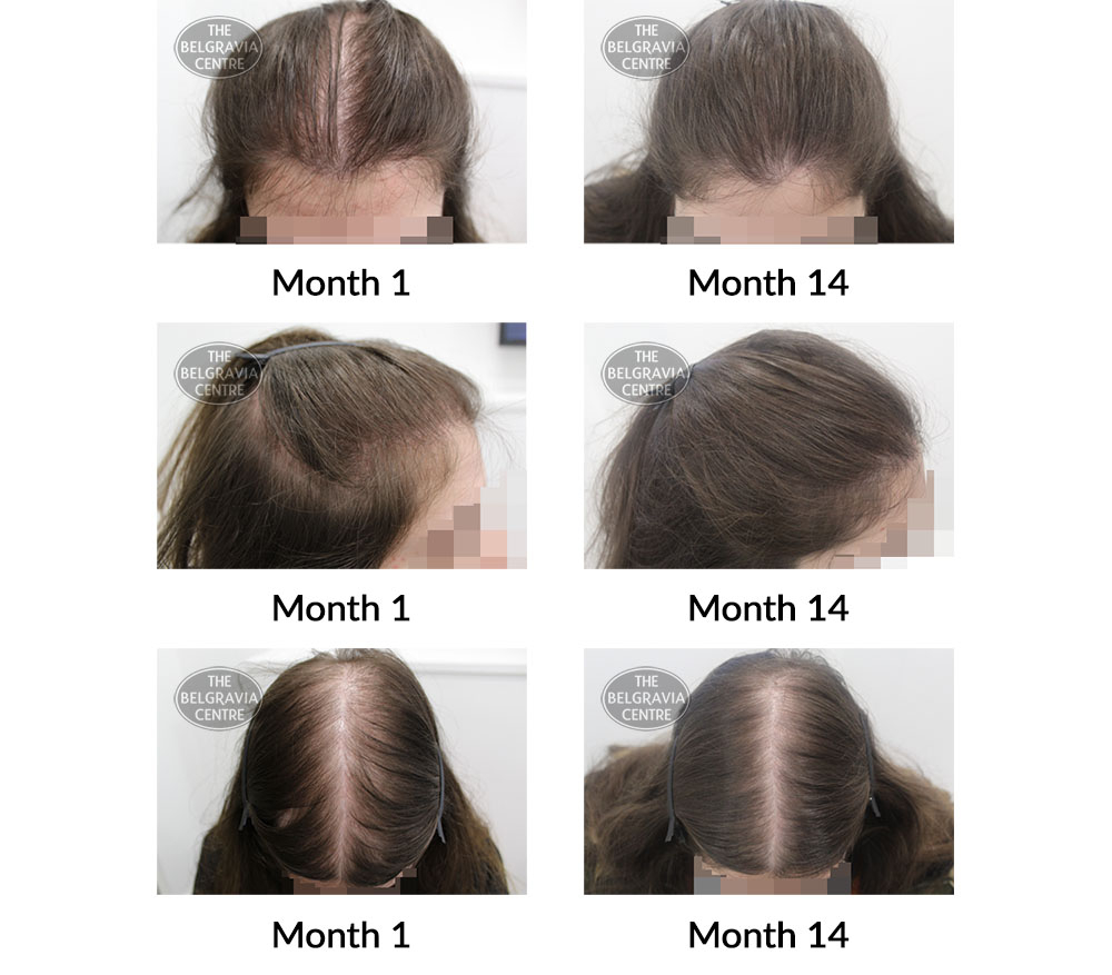 female pattern hair loss the belgravia centre 397983 18 05 2021