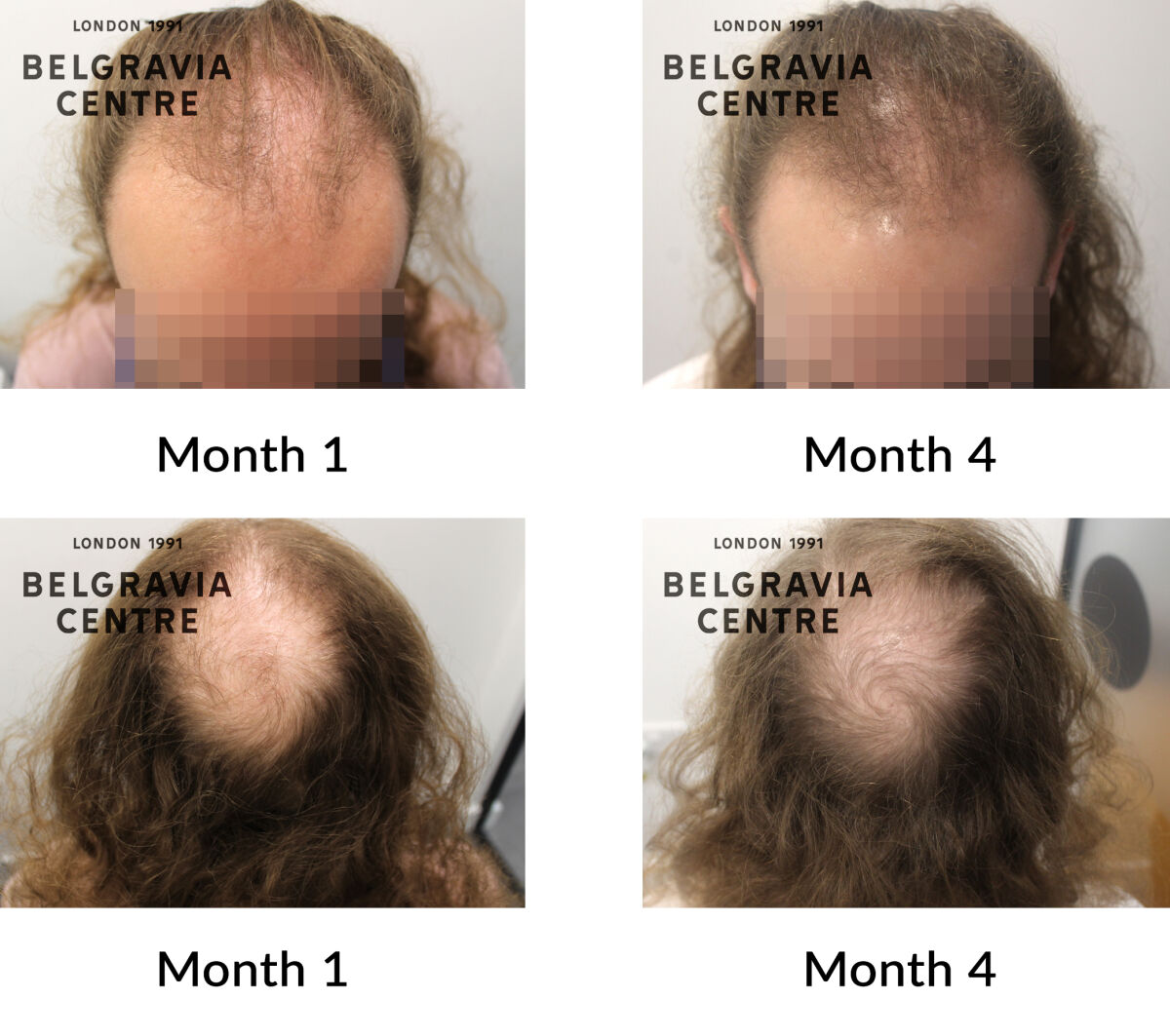male pattern hair loss the belgravia centre 447119