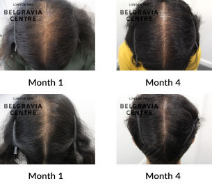 male pattern hair loss the belgravia centre 438855
