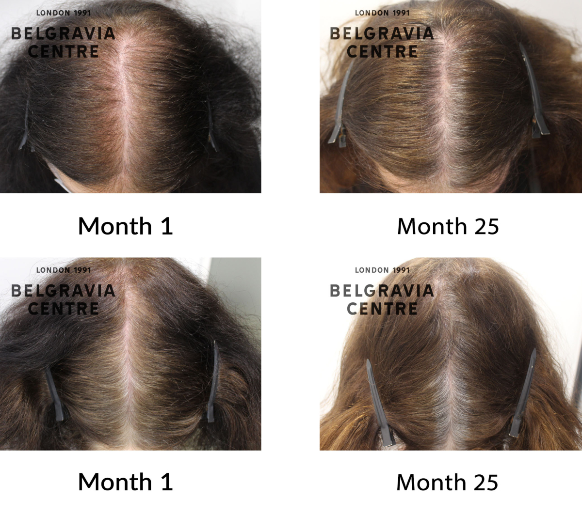 telogen effluvium chronic and female pattern hair loss the belgravia centre 428888