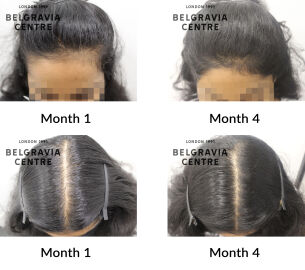 female pattern hair loss the belgravia centre 441627