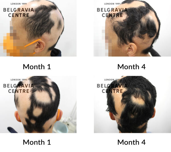 alopecia areata the belgravia centre 436794