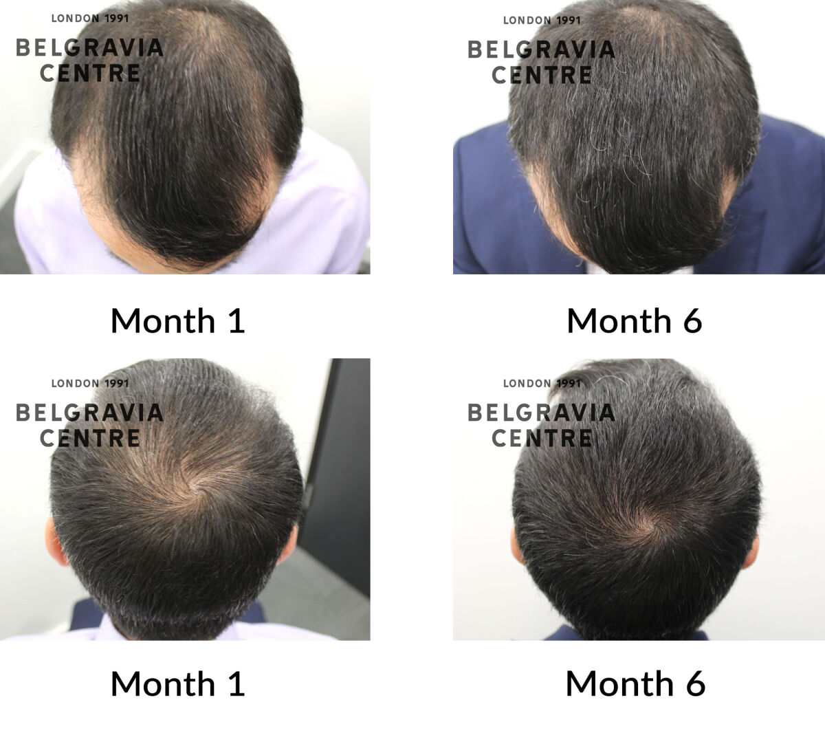 male pattern hair loss the belgravia centre 394464