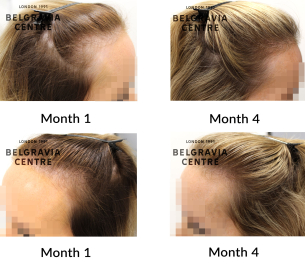 female pattern hair loss and diffuse thinning the belgravia centre 459678