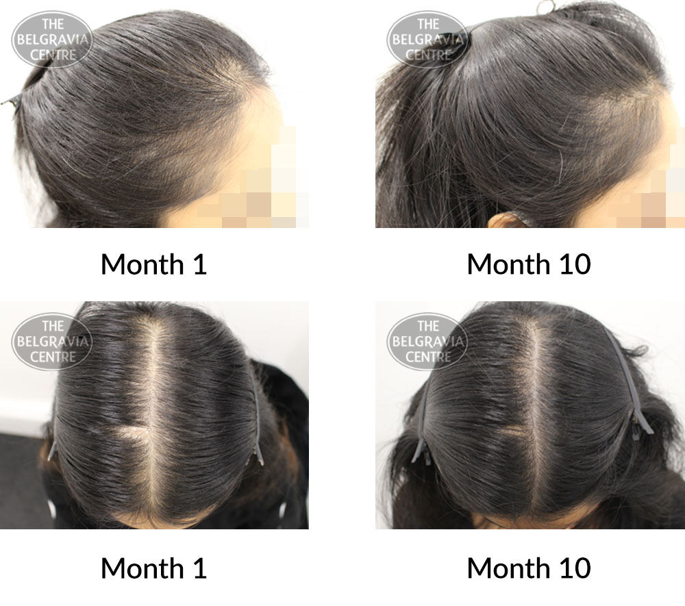 female pattern hair loss the belgravia centre 393422 03 09 2020