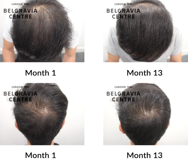 male pattern hair loss the belgravia centre 424259