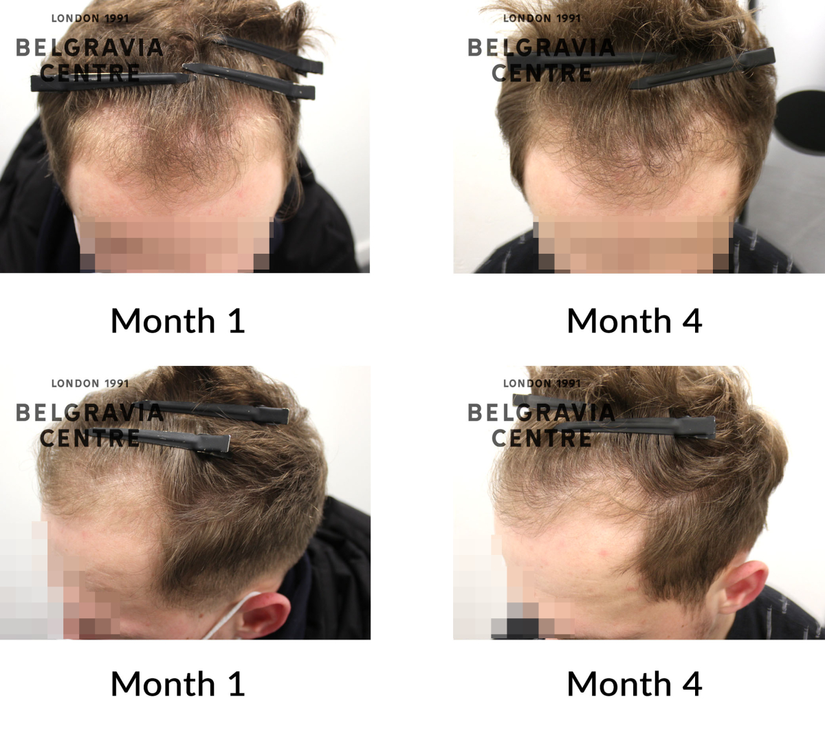 male pattern hair loss the belgravia centre 389448