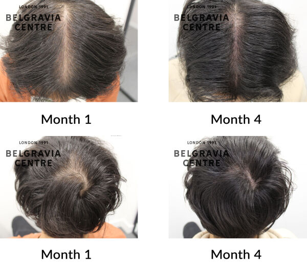 male pattern hair loss the belgravia centre 446544