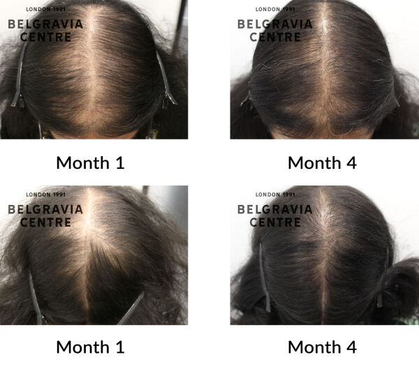 female pattern hair loss the belgravia centre 440444